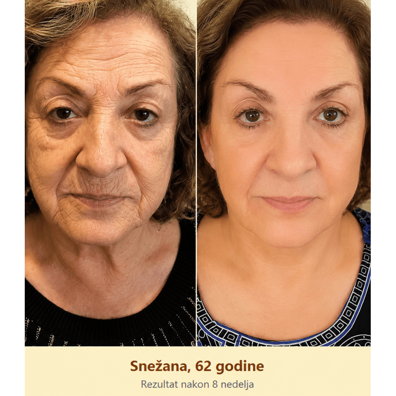 rezultat korišćenja kreme na licu žene od 62 godine nakon osam nedelja